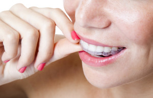 Invisalign aligners in Torrance are clear. 