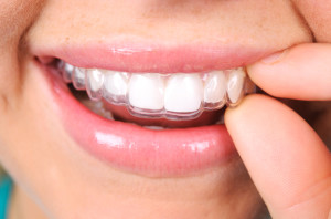 Invisalign in Long Beach takes less time to straighten teeth than traditional braces. 